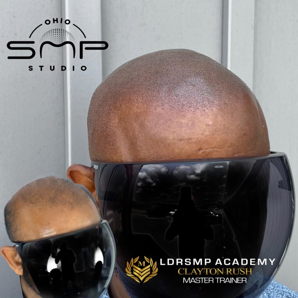 Scalp Micropigmentation